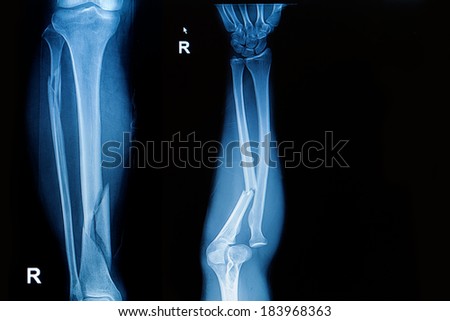 x-ray image  show fracture both bone of leg  and fracture shaft of ulnar of forearm