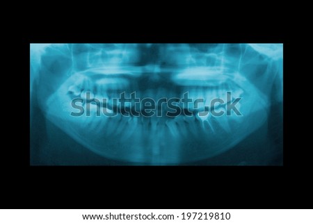 Panoramic dental X-ray for Orthodontics and Jaw Orthopedics