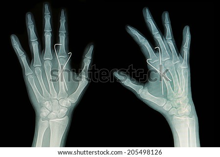 Film x-ray of hand fracture : show fracture metacarpal bone insert with k-wire (Kirschner wire)