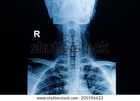 x-ray image of cervical spine, neck x-ray image