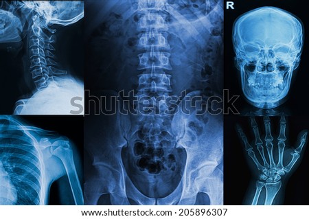 Collection x-rays image of human ,show upper extremity body part of human