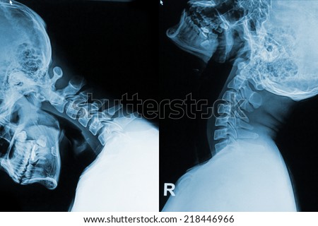 x-ray image of neck show neck pain in flex and extend position