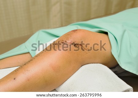 Stitched wound after a surgical knee and leg