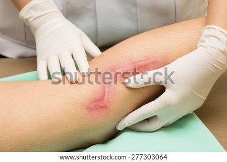 Wound scar on leg after surgery