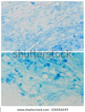 package of slide smear show Mycrobacterium tuberculosis ,pink-red bacilli