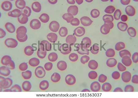 blood smear : Abnormal Red blood cells