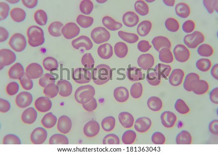 blood smear : Abnormal Red blood cells