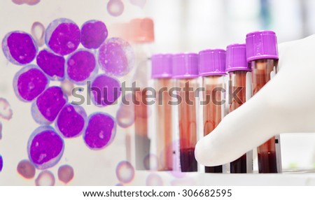 Leukemia cells and scienctist testing in laboratory