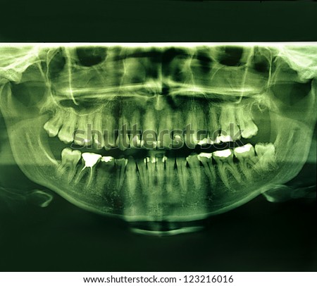 X-Ray image of a human jaw, mouth and teeth with plumbing.