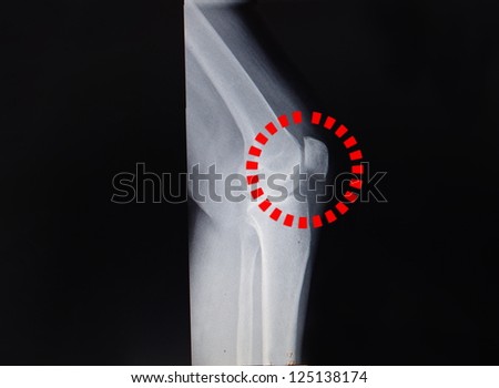 x-ray knee and kneecap on black background ( narrowing knee ) with marked kneecap