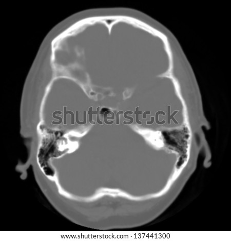 Brain and head CT( computed tomography imaging )