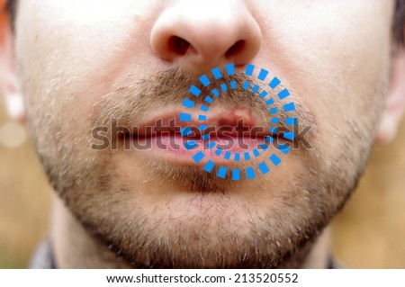 Closeup of a common cold sore virus herpes. Marked cold sores on the lips of a man with a beard