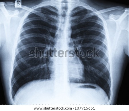 Normal thoracic radiograph without any findings