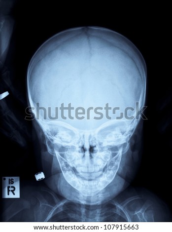 Radiograph of a child\'s head after accident
