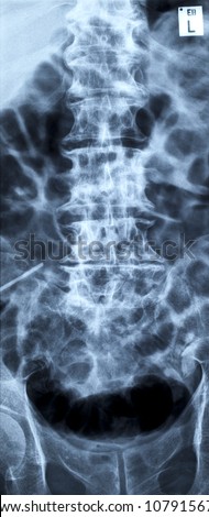 Lumbar disc herniation, lumbar spine radiograph anterior-posterior