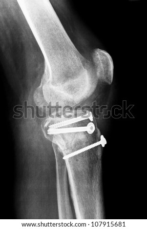 Osteosynthesis of a right human knee after accident, lateral radiograph after surgery