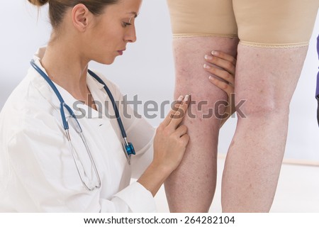 doctor showing varicose veins from an elderly woman