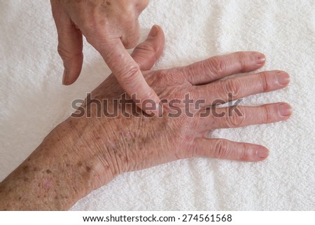 old stain on the skin- Skin disease on hands