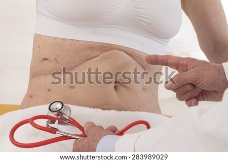 Surgeon pointing Stomach of a senior woman with big scars