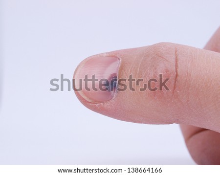 Subungual hematoma - collection of blood underneath fingernail (black toenail) medical condition. Aka runner or tennis toe