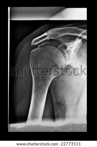 Medical X-Ray imaging of a shoulder, used in diagnostic radiology of skeleton bones