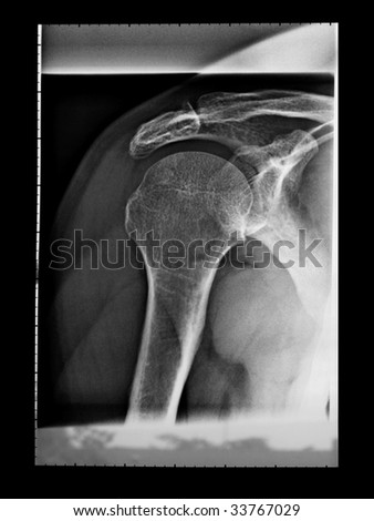 Medical X-Ray imaging of a shoulder, used in diagnostic radiology of skeleton bones