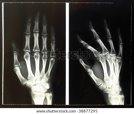 x ray hand. stock photo : Medical X-Ray