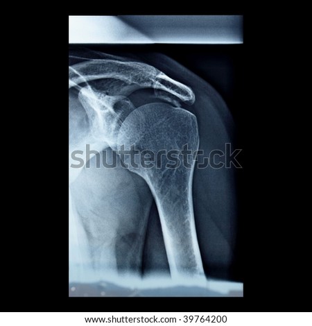 Medical X-Ray imaging of a shoulder