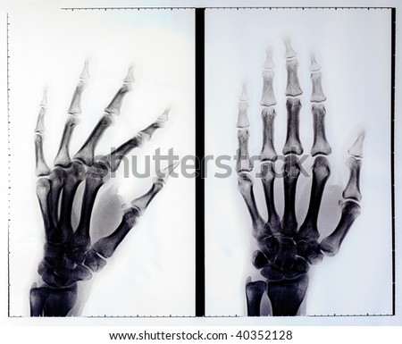 Medical X-Ray imaging of hand fingers used in diagnostic radiology of skeleton bones