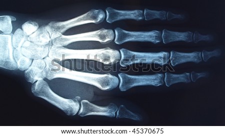 Medical X-Ray imaging of hand fingers used in diagnostic radiology of skeleton bones - (16:9 ratio)