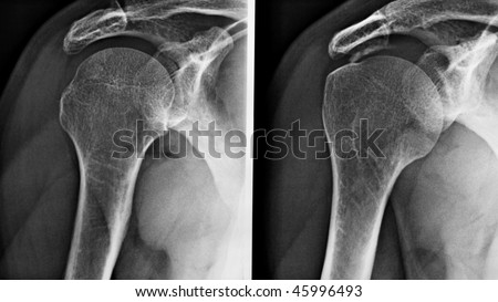 Medical X-Ray imaging of a shoulder, used in diagnostic radiology of skeleton bones - (16:9 black and white)