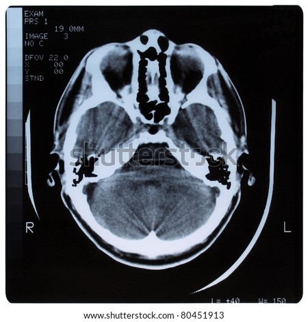 Medical healtcare X ray imaging of human brain skull bones xray nhs