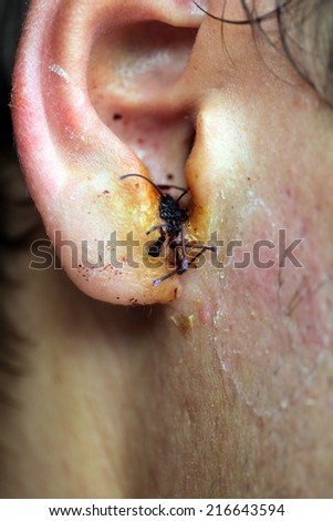 Head injury. Medical seams on the ear men