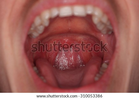 tonsil throat