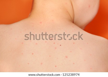 Boy with chicken pox rash