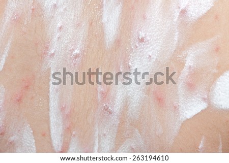Detail baby with chicken pox rash