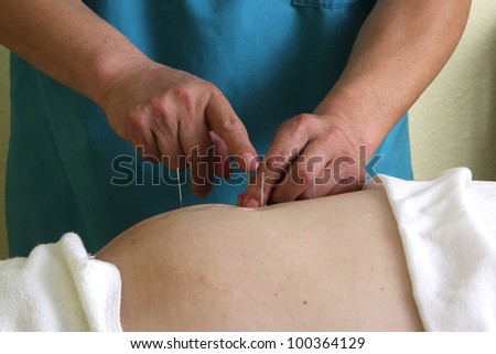 acupuncture / hands of a man placing acupuncture needles on a man\'s stomach.