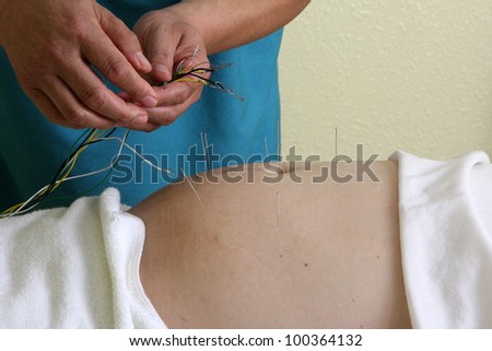 acupuncture / hands of a man placing acupuncture needles on a man\'s stomach.
