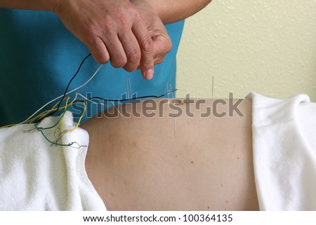 acupuncture / hands of a man placing acupuncture needles on a man's stomach.