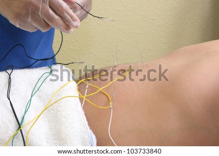 Acupuncture / Hands of a man placing acupuncture needles on a man's stomach.