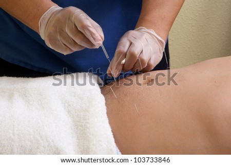 Acupuncture / Hands of a man placing acupuncture needles on a man\'s stomach.
