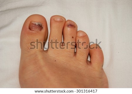 foot nail problems