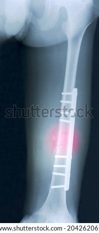 Film x-ray show fracture shaft of femur insert plate and screw for fix leg\'s bone, marking in red color