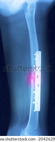 Film x-ray show fracture shaft of femur insert plate and screw for fix leg\'s bone, marking in red color