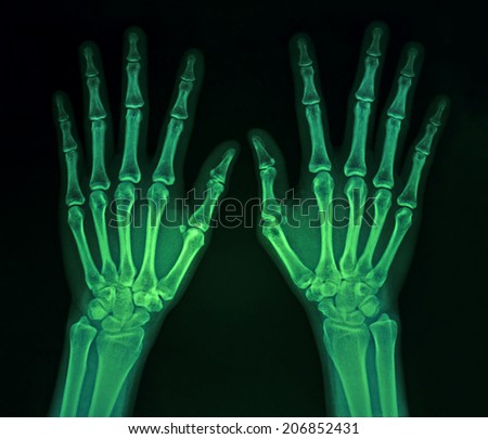Film x-ray normal both human\'s hands in green color
