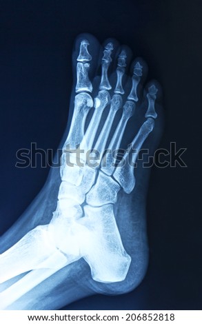 Film x-ray normal human's foot lateral
