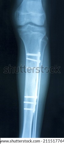 Film x-ray show fracture shaft of tibia and fibular insert plate and screw for fix leg's bone
