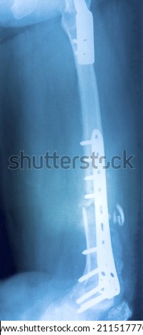 Film x-ray show fracture shaft of femur insert plate and screw for fix leg's bone