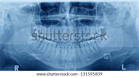 Panoramic x-ray image of teeth. Problem with wisdom tooth.