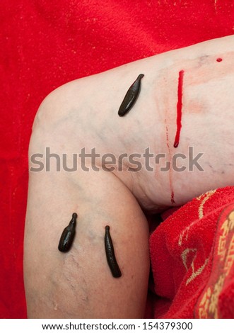 photo of leeches planted on patient and sucking blood